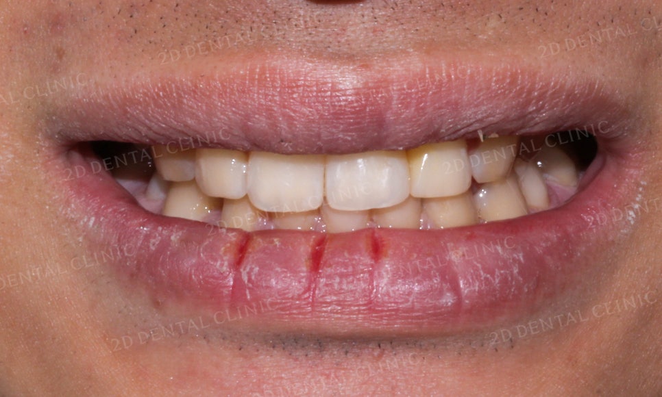 [앞니교정] 벌어진 앞니, 부분교정으로 앞니교정하기! by.2D치과(투디치과) 관련 이미지 10