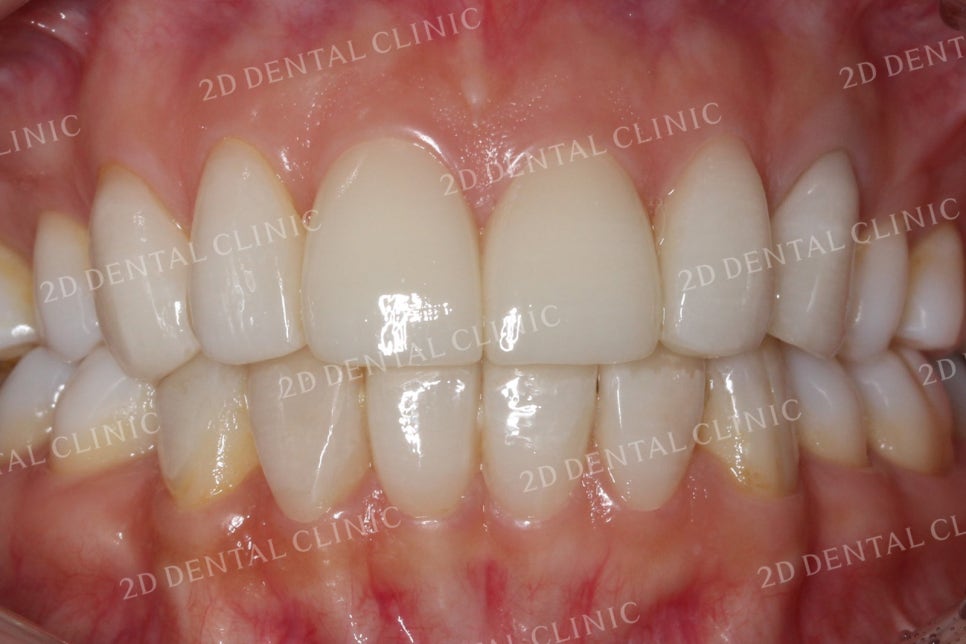 치아틈새를 완벽하게 메꾸자! 블랙트라이앵글 쎄라필름으로 완전 삭제! by.투디치과(2D치과) 관련 이미지 10