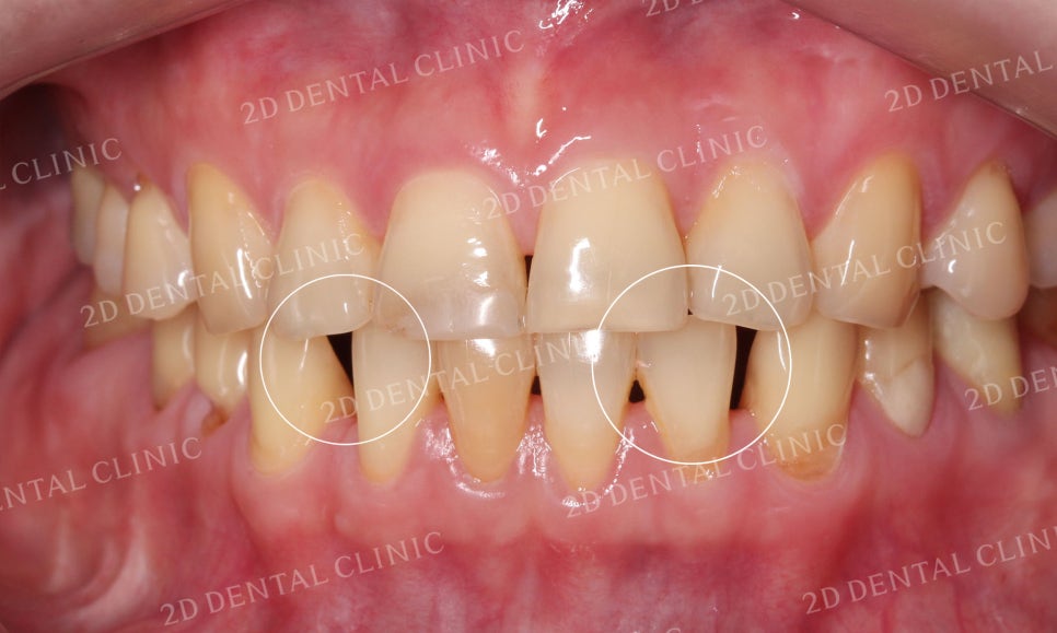 누렇고 손상된 치아를 밝고 가지런하게! by. 투디치과(2D치과)_블링스 시술후기 관련 이미지 5