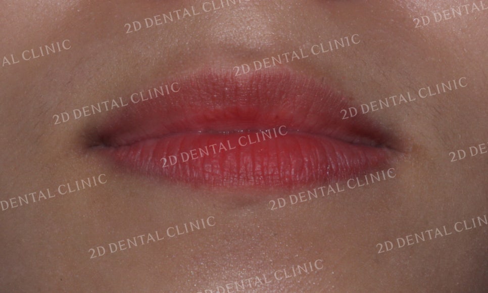 토끼앞니, 튀어나온 앞니 부분교정 후기! by.투디치과(2D치과) 관련 이미지 7