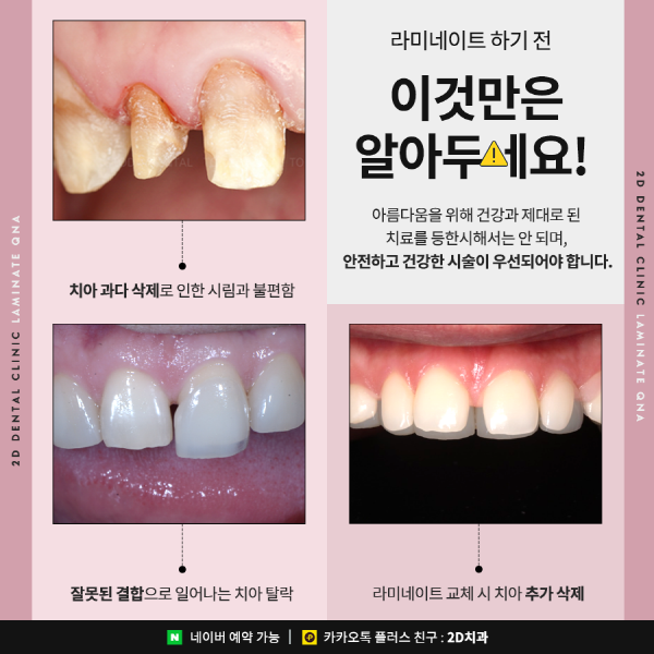 라미네이트 시술 전이라면? 이건 관련 이미지 2