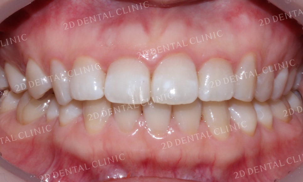 [투디교정] 덧니교정, 앞니교정으로 치열을 고르게! by.투디치과(2D치과) 관련 이미지 14