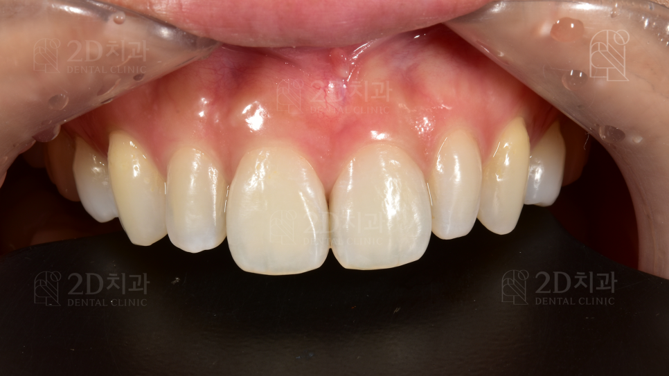 왜소치 라미네이트  신논현역 2D치과 관련 이미지 3