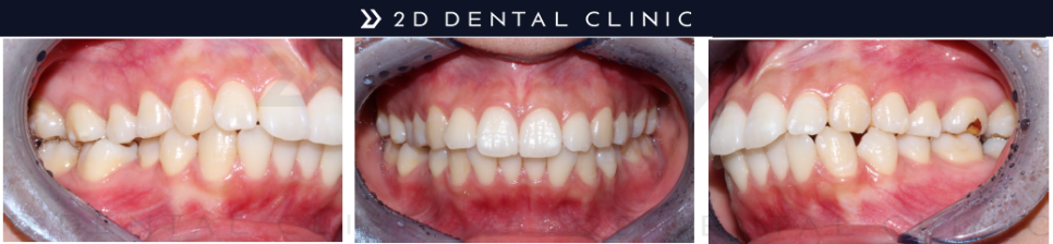 돌출입, 클리피씨로 교정기간과 통증을 최소화! 관련 이미지 4