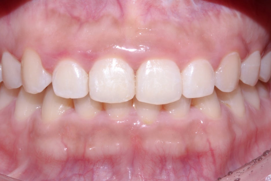 옥니교정 방법! 세라믹교정 Case 관련 이미지 11