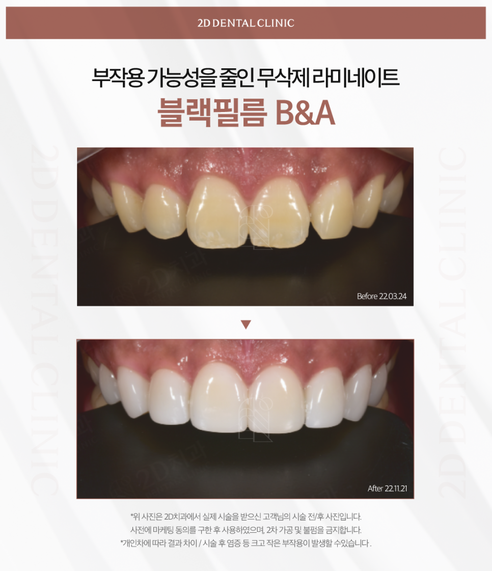 광주무삭제라미네이트 심미보철 치아 지키면서 예쁜 모양이 되려면 관련 이미지 7
