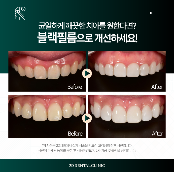광주무삭제라미네이트 블랙필름으로 치아 반점 개선하기 관련 이미지 6