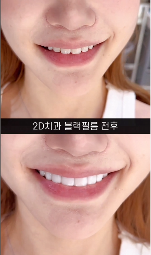 무삭제라미네이트 치아삭제없는 0.1mm 얇은 블랙필름 관련 이미지 11