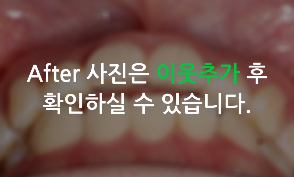 나비앞니 교정, 투디교정으로 빠르게 완성하는 방법! 관련 이미지 9