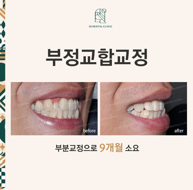 [앞니교정]부정교합교정, 부분교정으로 완성하기! by.투디치과(2D치과) 관련 이미지 1