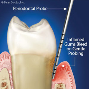 2021 스켈링 비용, 치석제거 스케일링 잇몸치료 가격 총정리 관련 이미지 16