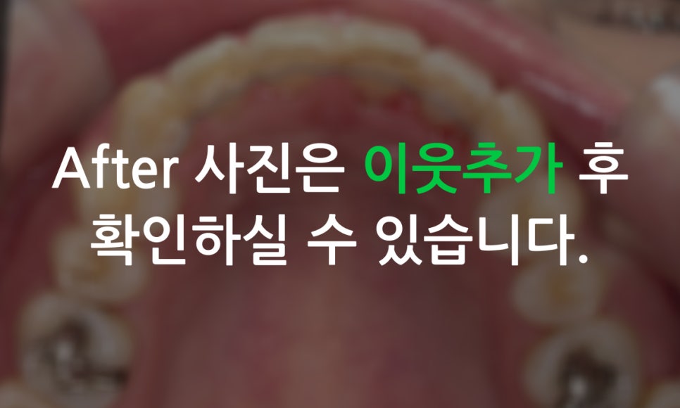 덧니교정 2D교정 (부분교정) 후기 관련 이미지 9