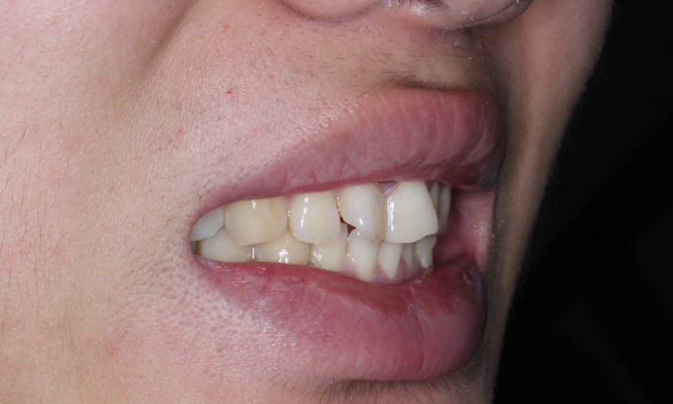 나비치아교정! 15개월만에 빠른 교정 by.투디치과(2D치과) 관련 이미지 8