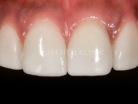 라미네이트 깨짐 10년 무상보증되는 블랙필름 관련 이미지 6