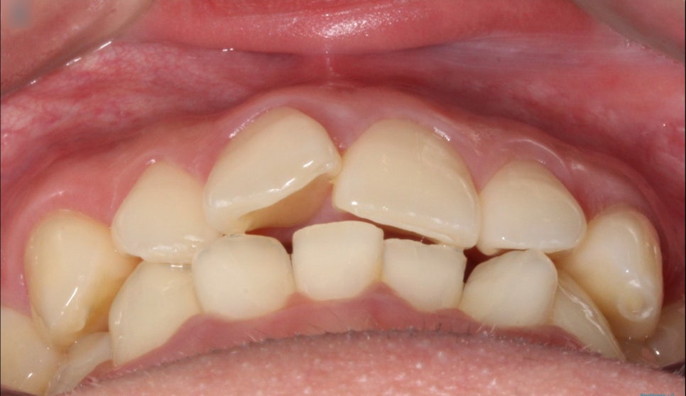 부분교정으로 삐뚤어진 앞니 예뻐지는 방법 관련 이미지 17