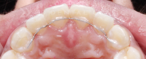 블랙필름 치아 삭제없는 무삭제라미네이트 후기 관련 이미지 10