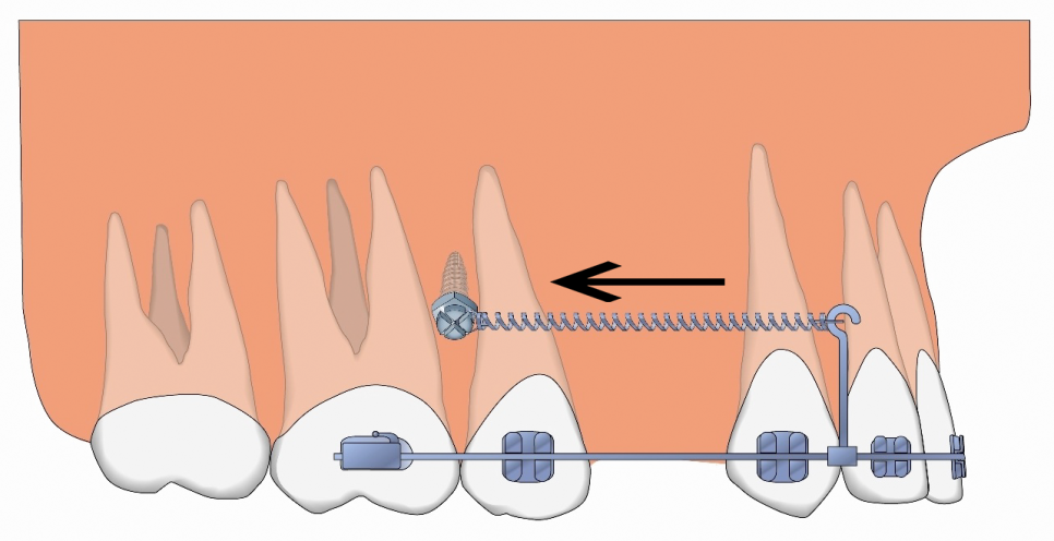 돌출입 유형 및 증상, 치과 내원 전 자가진단! 관련 이미지 11