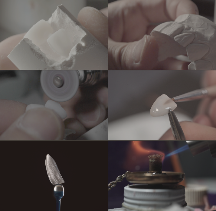 무삭제 라미네이트 비용 알아보기 ! 관련 이미지 8