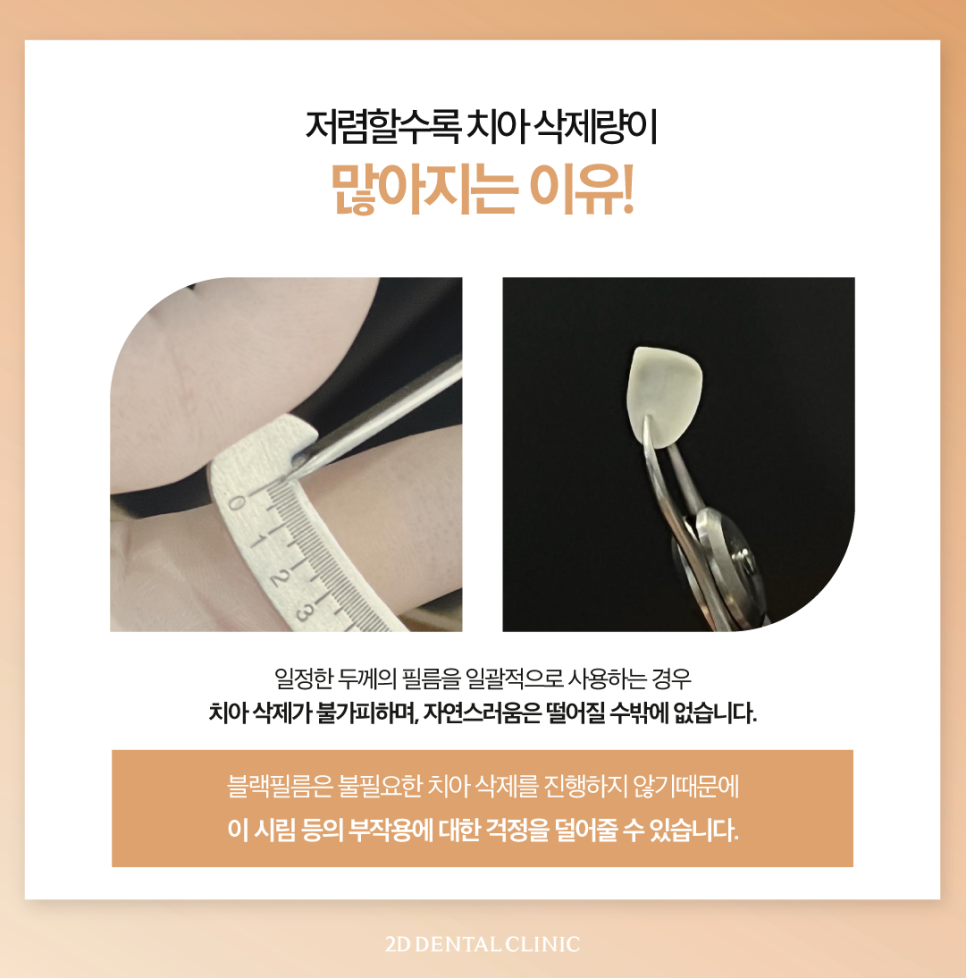 대구무삭제라미네이트 앞니깨짐비용보다 이것에 집중해 주세요! 관련 이미지 6