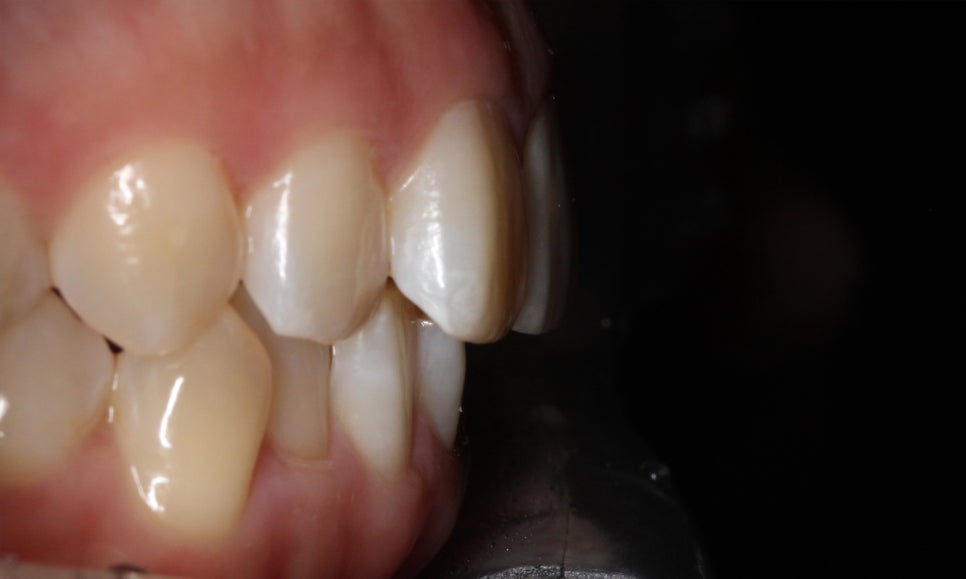 양악교정 송곳니교정 중심으로 관련 이미지 3