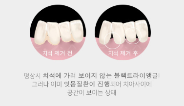 치아 블랙트라이앵글 원인, 예방, 치료 무삭제라미네이트 관련 이미지 6