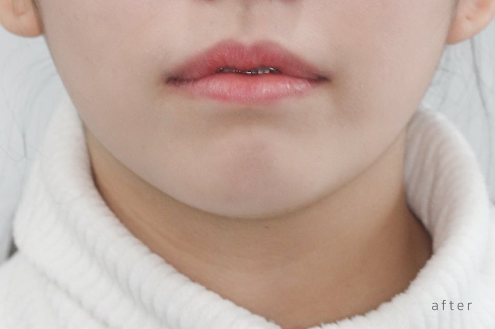 [돌출입 무턱] 안모교정 진행중! by.투디치과(투디치과)전체교정 관련 이미지 12