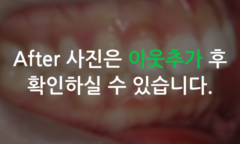 세라믹교정 앞니틀어짐 교정 사례 관련 이미지 11