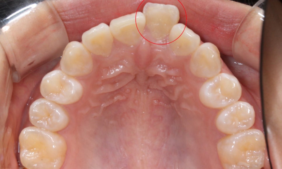 앞니돌출 급속교정 Case feat. 2D교정 관련 이미지 6