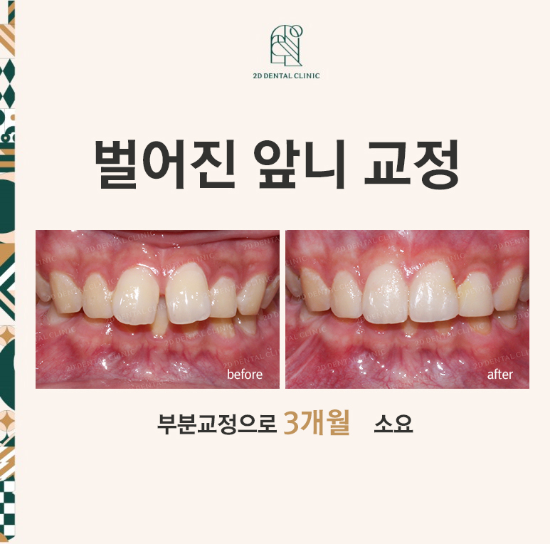 [앞니교정] 벌어진 앞니, 부분교정으로 앞니교정하기! by.2D치과(투디치과) 관련 이미지 1