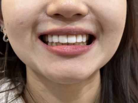 무삭제 라미네이트 개인의 치아디자인에 맞춘 단 하나밖에 없는 치아디자인 블랙필름 관련 이미지 11