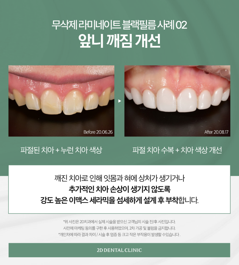 라미네이트하는이유 앞니심미치료 더욱 아름다운 치아로! 관련 이미지 5