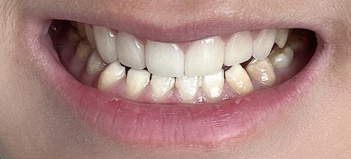 무삭제 라미네이트 개인의 치아디자인에 맞춘 단 하나밖에 없는 치아디자인 블랙필름 관련 이미지 5