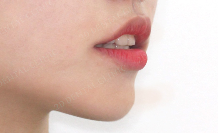 우디의 교정일기ㅣ덧니 치아교정 후기 (feat.부정교합) 관련 이미지 13