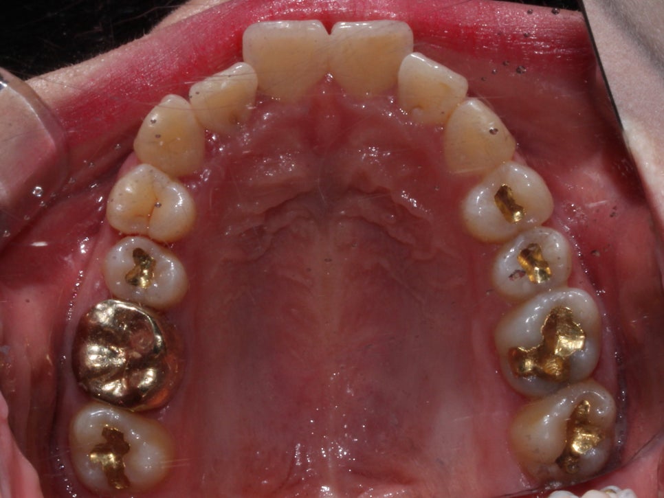 덧니 투명교정 8개월 치료 사례 관련 이미지 7