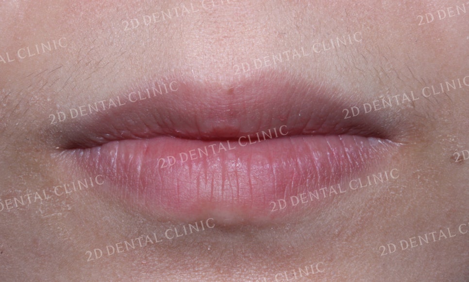 나비치아교정, 부분교정으로 나비치아 탈출하기! by.투디치과(2D치과) 관련 이미지 9