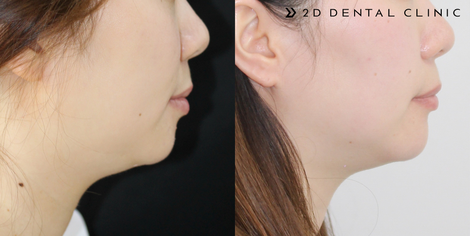 발치교정 돌출입 케이스, 교정전문 2D치과 관련 이미지 15