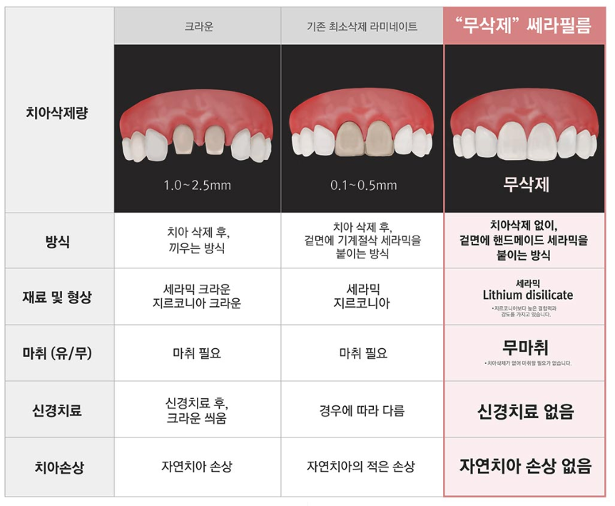 라미네이트 치료 전 체크해야할 부분은? 관련 이미지 4