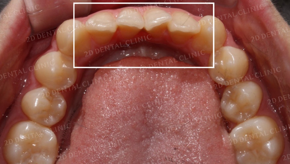 덧니치아교정, 클리피씨 전체교정으로 완벽하게! by.투디치과(2D치과) 관련 이미지 18
