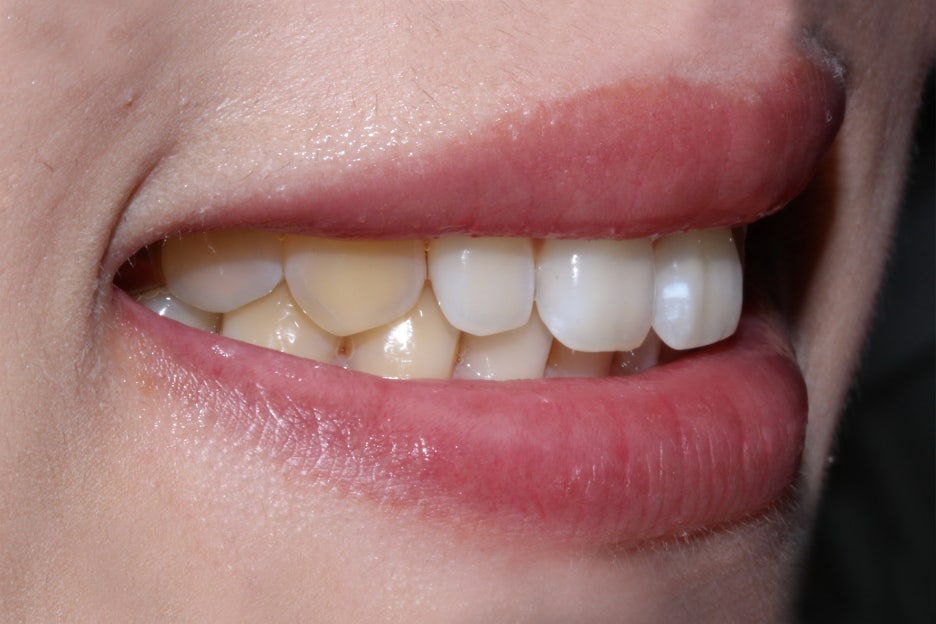 벌어진앞니 치간이개 공간 삭제하기! 관련 이미지 2