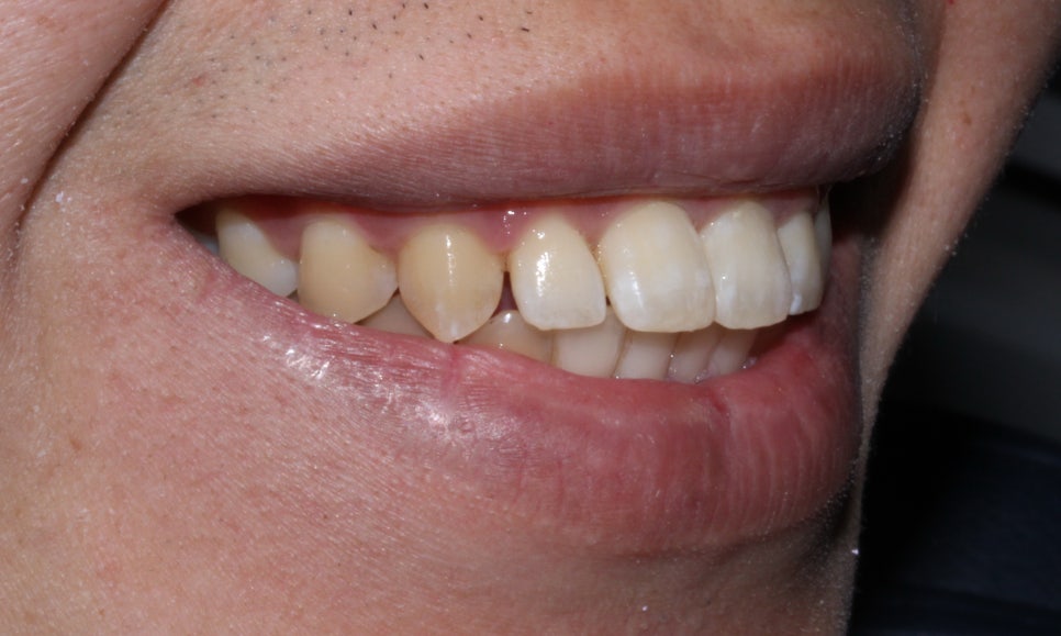 뻐드렁니 교정, 강남역치과에서 앞니 부분 교정한 후기! 관련 이미지 10