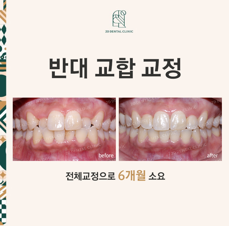 반대교합으로 물리는 치아를 바른 교합으로 교정하기! by.투디치과(2D치과) 관련 이미지 1
