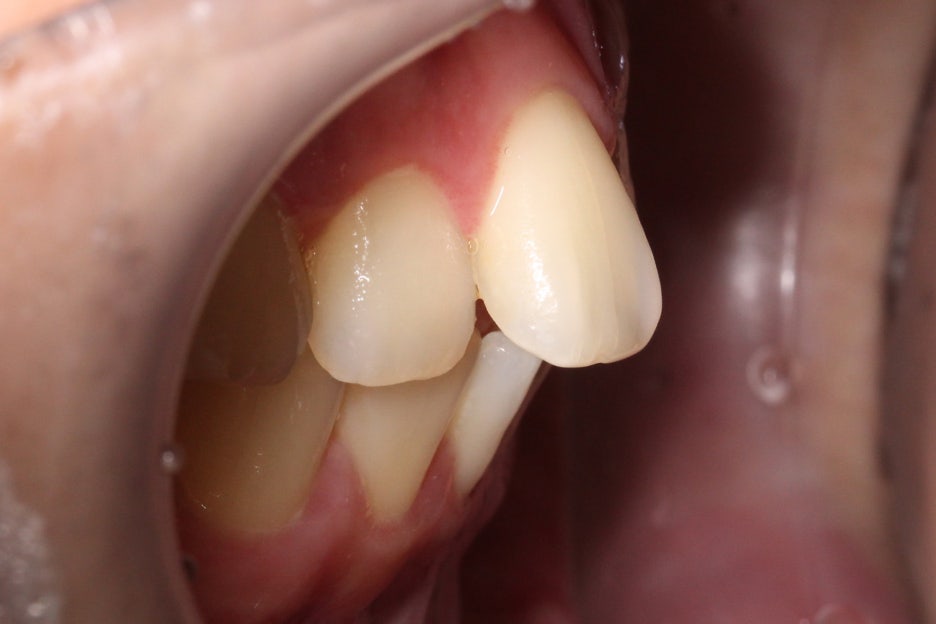 논현동치과 윗니부분교정 후기 관련 이미지 3