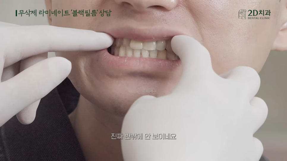 [블랙필름 상담 받고 왔어요] #4 크라운 위에 블랙필름 가능한가요? 관련 이미지 9