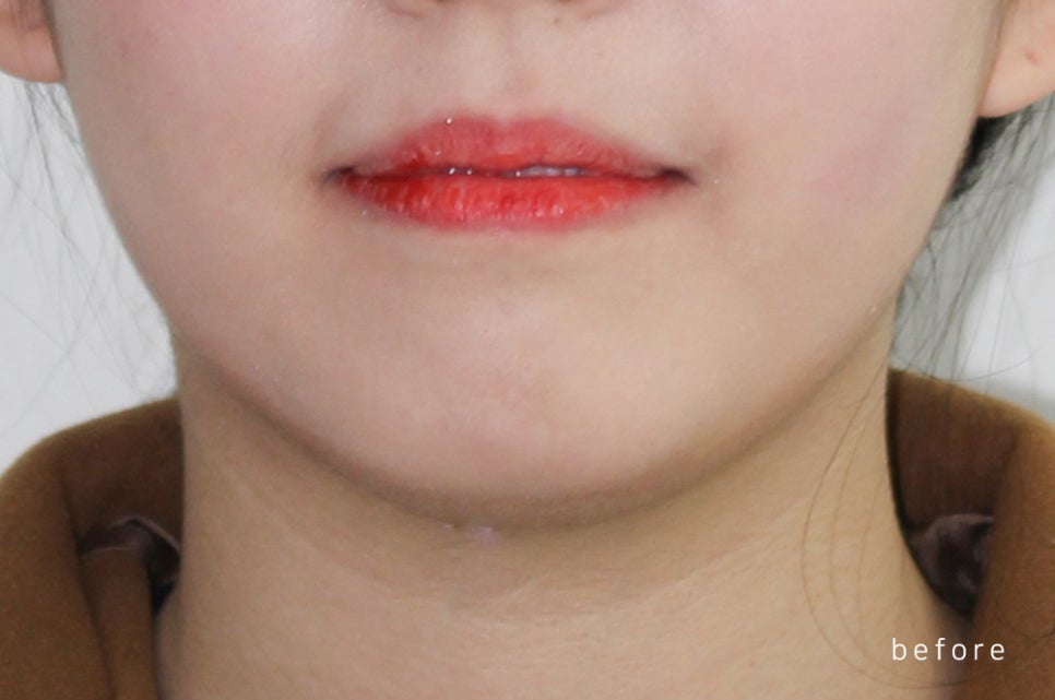 [돌출입 무턱] 안모교정 진행중! by.투디치과(투디치과)전체교정 관련 이미지 2