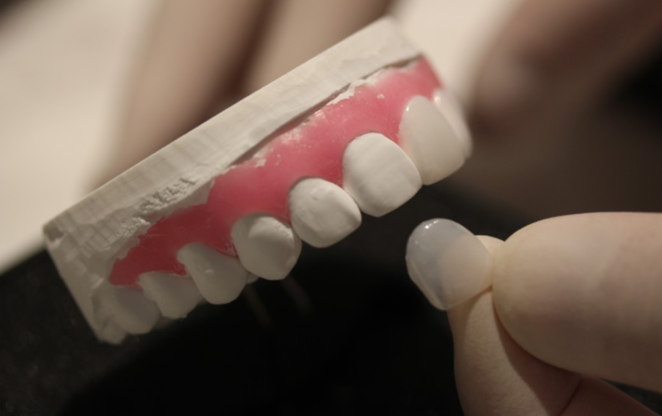 자연스러운 내 치아같은 무삭제라미네이트후기 관련 이미지 11