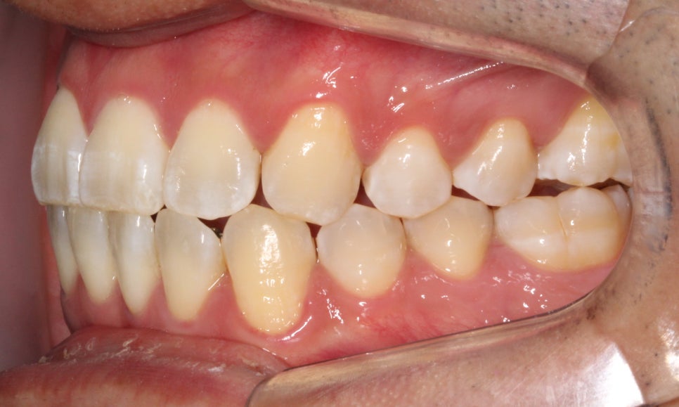 앞니 덧니 고민, 부분 설측 교정으로 해결한 사례 관련 이미지 7