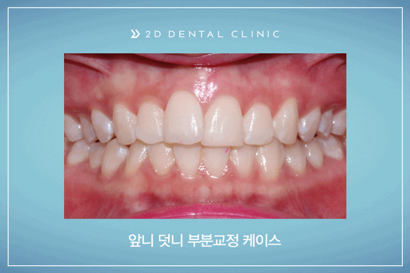 앞니 덧니 부분교정 케이스 전후비교, 교정전문 2D치과 관련 이미지 1