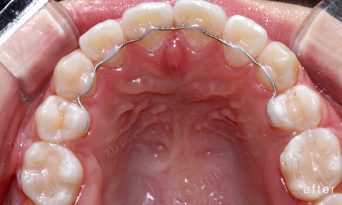 우디의 교정 일기ㅣ부정 교합 치아교정 후기 관련 이미지 9