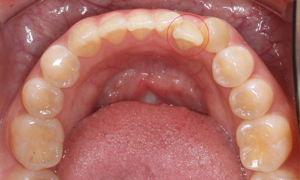 앞니돌출 급속교정 Case feat. 2D교정 관련 이미지 7