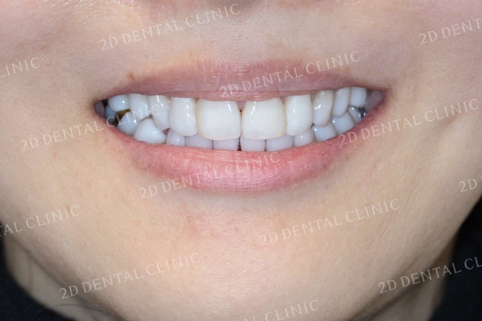 치아틈새를 완벽하게 메꾸자! 블랙트라이앵글 쎄라필름으로 완전 삭제! by.투디치과(2D치과) 관련 이미지 1